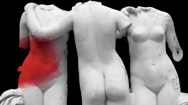 Ендометріоз