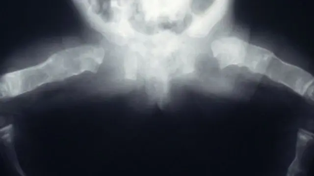 ภาพเอ็กซเรย์ขาของทารกที่มีอาการกระดูกเปราะ