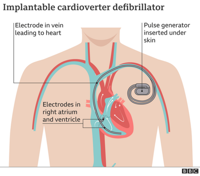"Heart Starting device": [Christian Eriksen] go get 'Implantable cardioverter-defibrillator' afta cardiac arrest