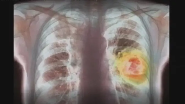 ক্যান্সার