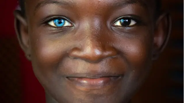 'Heterochromia irides'