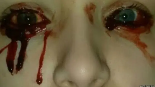 Msichana mwingine Marnie-Rae Harvey hutokwa na damu machoni lakini madaktari hawaelewi chanzo chake ni nini