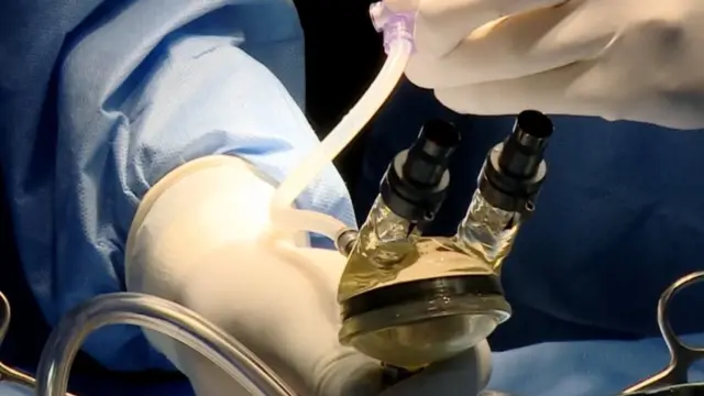 மூன்று வயதுக் குழந்தைக்கு உடலுக்கு வெளியில் செயற்கை இதயம்