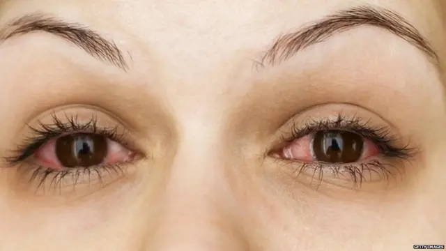 ਮਿਊਕੋਰਮਾਇਕੋਸਿਸ