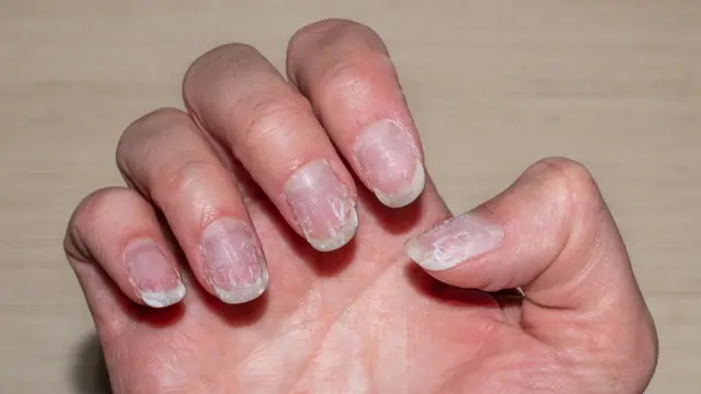 Unhas quebradiças