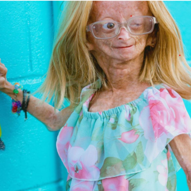 Adalia Rose - YouTuber wit Hutchinson-Gilford progeria genetic condition die at age 15