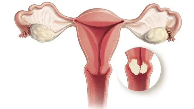 Cancer du col de l'utérus.