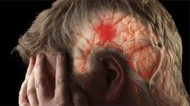 সাধারণত মস্তিষ্কে রক্ত চলাচলে ব্যাঘাত ঘটলে স্ট্রোক হয়