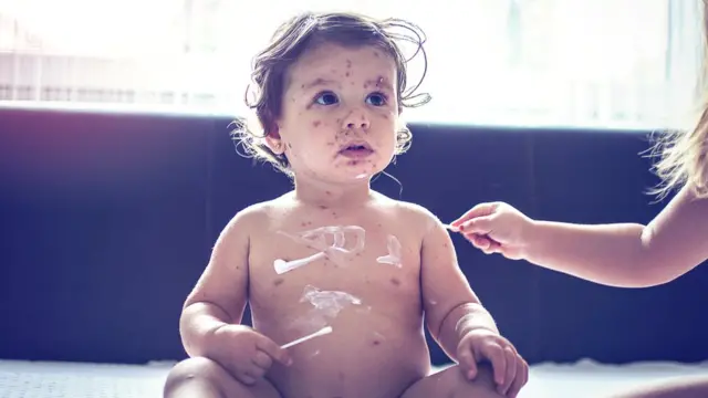 Bebé con sarampión.