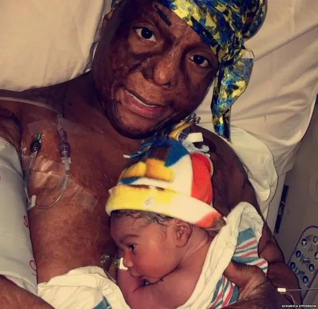 Mimi amesema amukuwa akifanyiwa upasuaji kila mwaka huko Cincinnati hadi alipokuwa na miaka 17