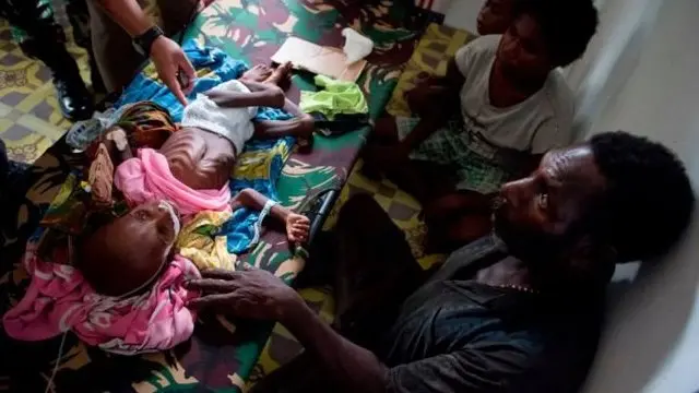 Anak di Asmat, Papua, dirawat karena campak dan gizi buruk.