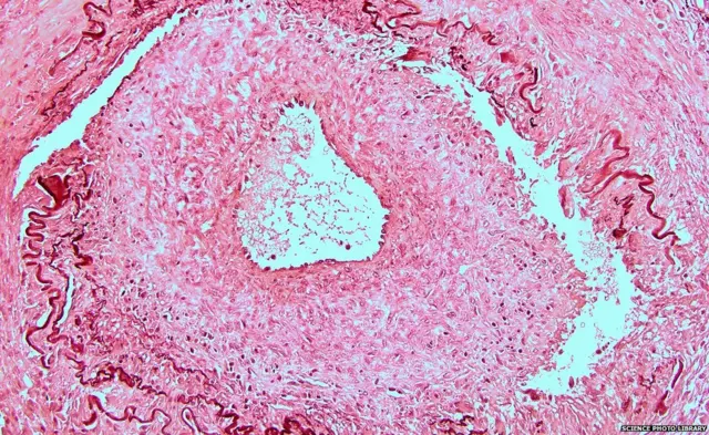 Sección de una arteria temporal afectada por ACG.