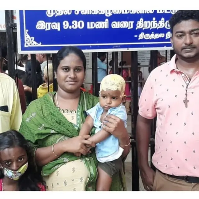 அரியவகை முகச்சிதைவால் பாதிக்கப்பட்ட சிறுமி தான்யா