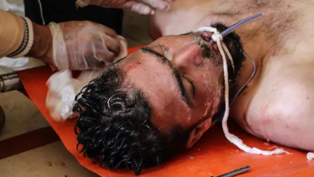 İdlib'in güneyindeki Han Şeyhun bölgesinde düzenlenen hava saldırısı nedeniyle tedavi gören bir kişi