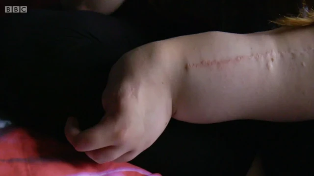 Cicatrices de operaciones pasadas en el brazo de Leah