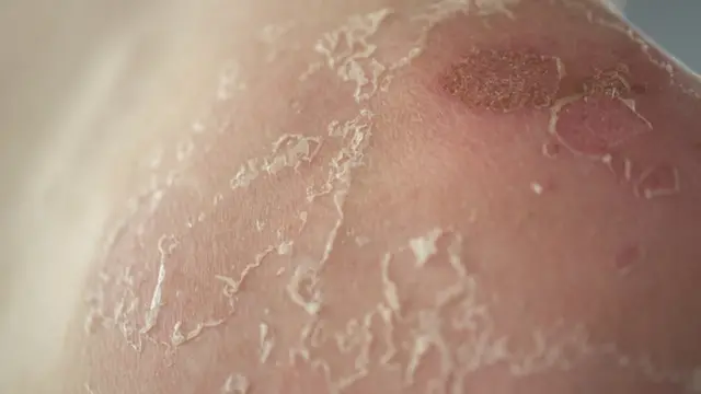 آفتاب سوختگی است