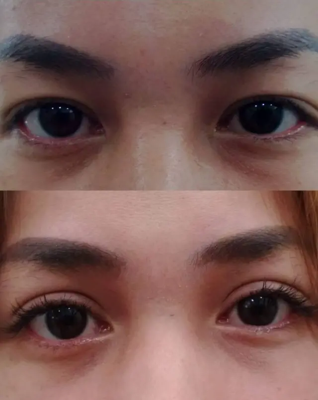 ก่อนและหลังการทำตาสองชั้น