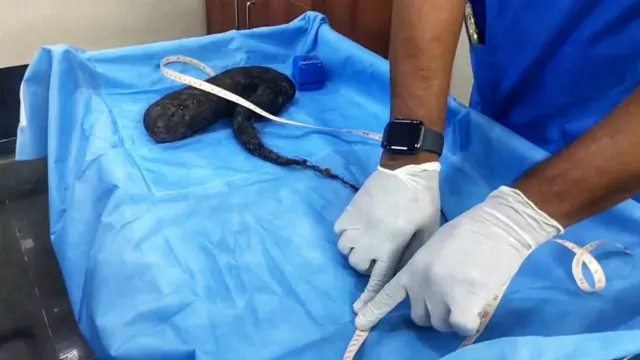 தலைமுடியை பிடுங்குவது, நகம் கடிப்பது மனநலம் சார்ந்த பிரச்னையா?