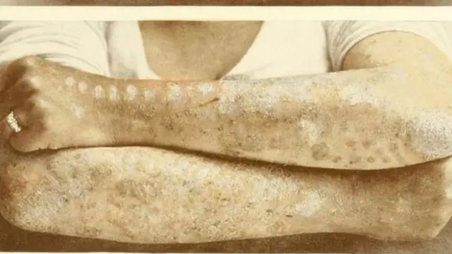 ਸੋਰਾਸਿਸ