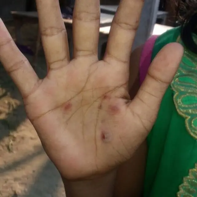 जला हुआ हाथ