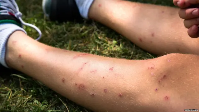 ਮੱਛਰਾਂ ਦੇ ਹਮਲੇ ਦੀਆਂ ਸ਼ਿਕਾਰ ਲੱਤਾਂ