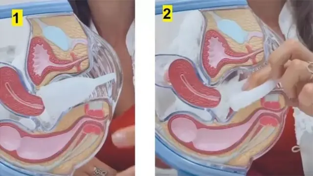 મૅન્સ્ટ્રુઅલ કપનો ઉપયોગ કરવાની રીત