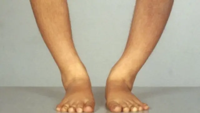 โรคกระดูกอ่อน