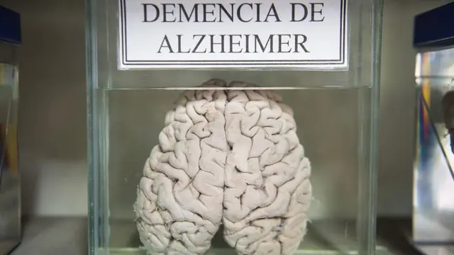 பதப்படுத்தப்பட்ட மனித மூளை