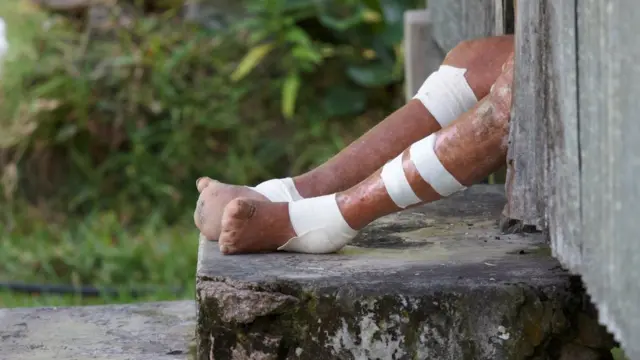 Piel de una persona con lepra.