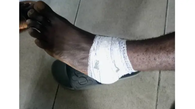 Foto gosiri ụkwụ otu onye so mee ngagharịiwe a merụrụ ahụ n'ụkwụ ya.