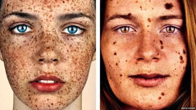 ફ્રેકલ્સ ધરાવતા લોકોની તસવીરો