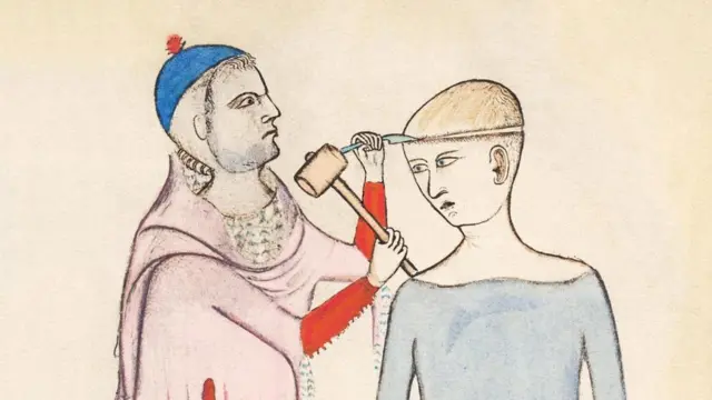 نقاشیای از قرن چهارده از سوراخ کردن جمجمه توسط گویدو داویجوانو