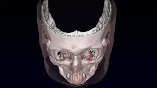 ภาพสแกนแสดงให้เห็นแม่เหล็กที่ฝังอยู่ในเบ้าตาเป็นจุดสีแดง