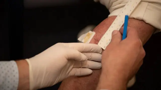 قرحة بورولي