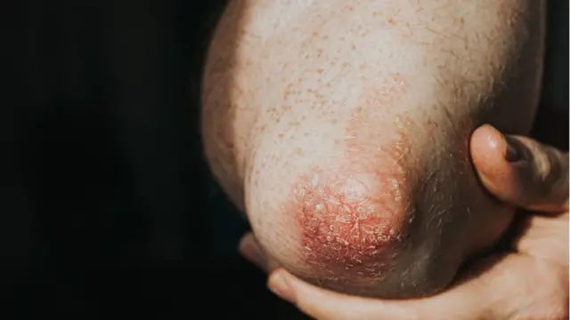 অটোইমিউন ডিজিজ