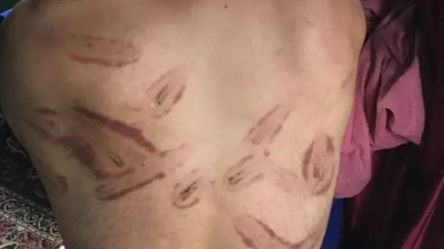 कश्मीर में एक व्यक्ति की पीठ पर टॉर्चर के निशान.