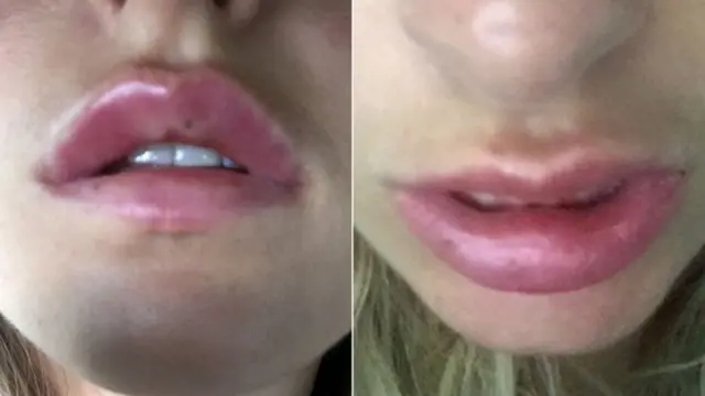 За словами д?вчини, одразу ж п?сля процедури губи занадто опухли