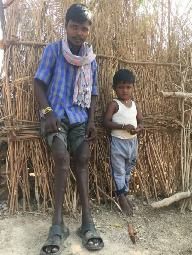 నల్లగొండలో ఫ్లోరైడ్ బాధితుడు