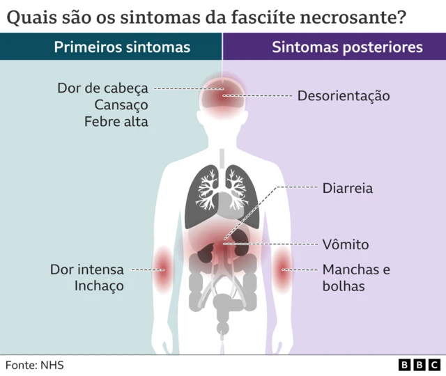 Infográfico mostra sintomas da fasciite necrosante