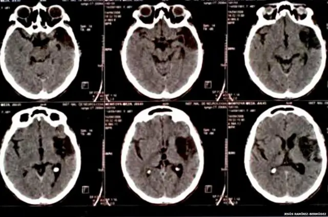 Daño cerebral en un paciente con síndrome de Cotard (Foto: Jesus Bermudez-Ramirez)