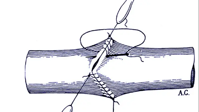 La anastamosis vascular de Carrel. (De A. Carrel (1902), "La Technique operatoire des anastomoses vasculaire et la transplantation des visceres", Medecine de Lyon)