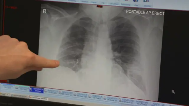 Le professeur Chalmers souligne les zones blanches qui montrent la présence de liquide dans les poumons