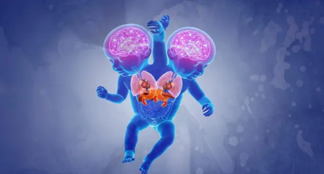 сиам эгиздери