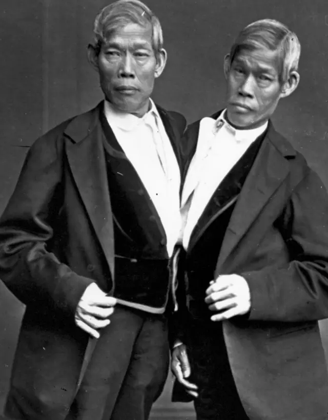 Сиамские близнецы развиваются из одной оплодотворенной яйцеклетки