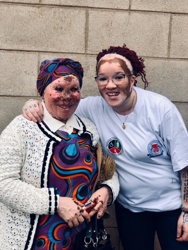 Njee Wangoi akiwa na mwathiriwa mwengine wa hali ya vitiligo