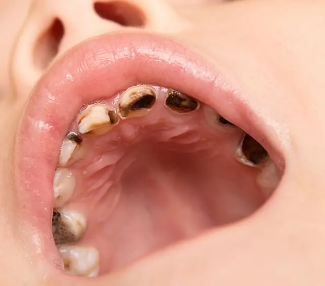 Dientes de niño con caries.
