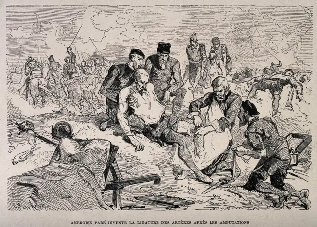 Ambroise Paré llevando a cabo una ligadura de arteria a un soldado amputado. Grabado en madera hecho por C. Maurand. (Foto: Iconographic Collections / Welcome Images vía Wikimedia Commons)
