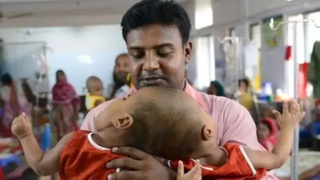 सयामी जुळे