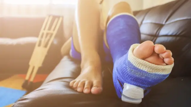 5 mitos comunes sobre fracturas de huesos y por qu no son ciertos - BBC  News Mundo