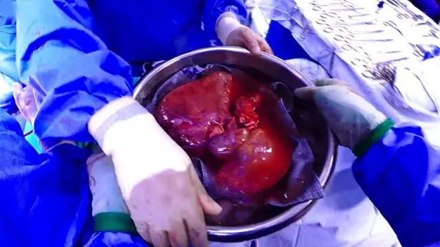 Perera recibe el hígado nuevo